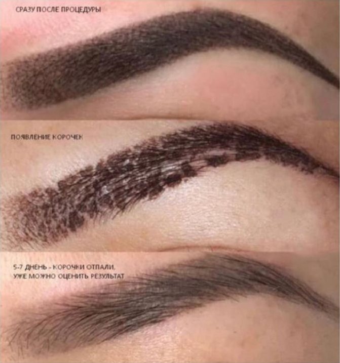 Этапы заживления