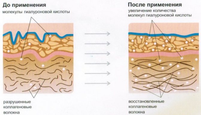 Филлеры для лица. Что это в косметологии, какие лучше, фото до, после процедуры