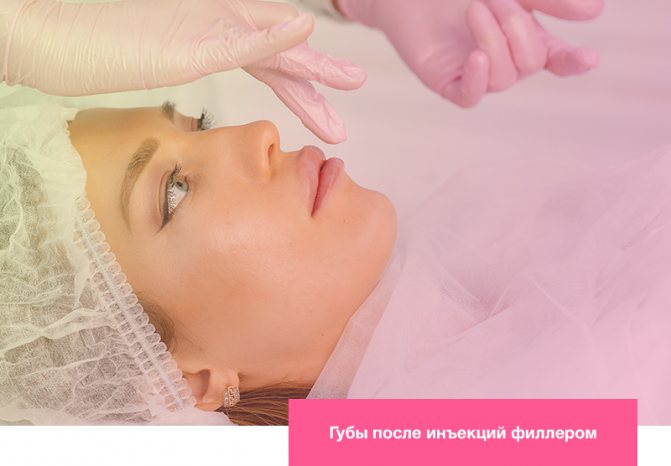 Губы после инъекций филлером