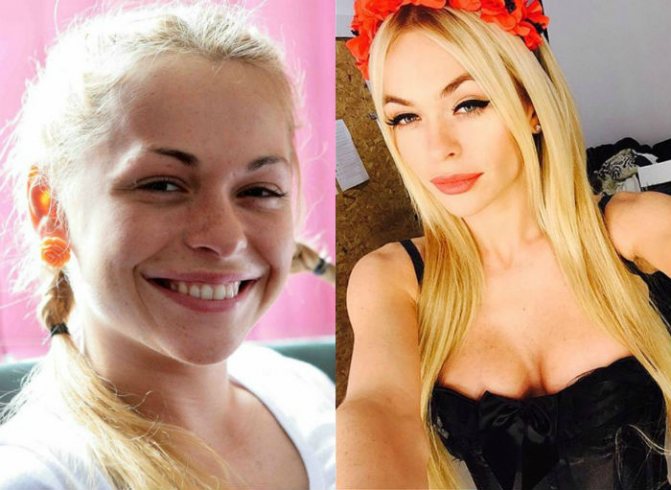 Хилькевич до и после пластики фото