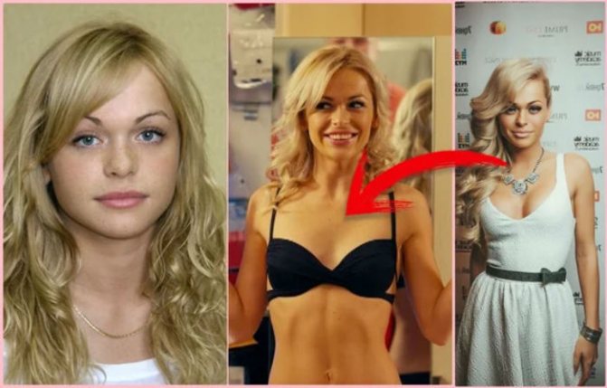 Хилькевич до и после пластики фото